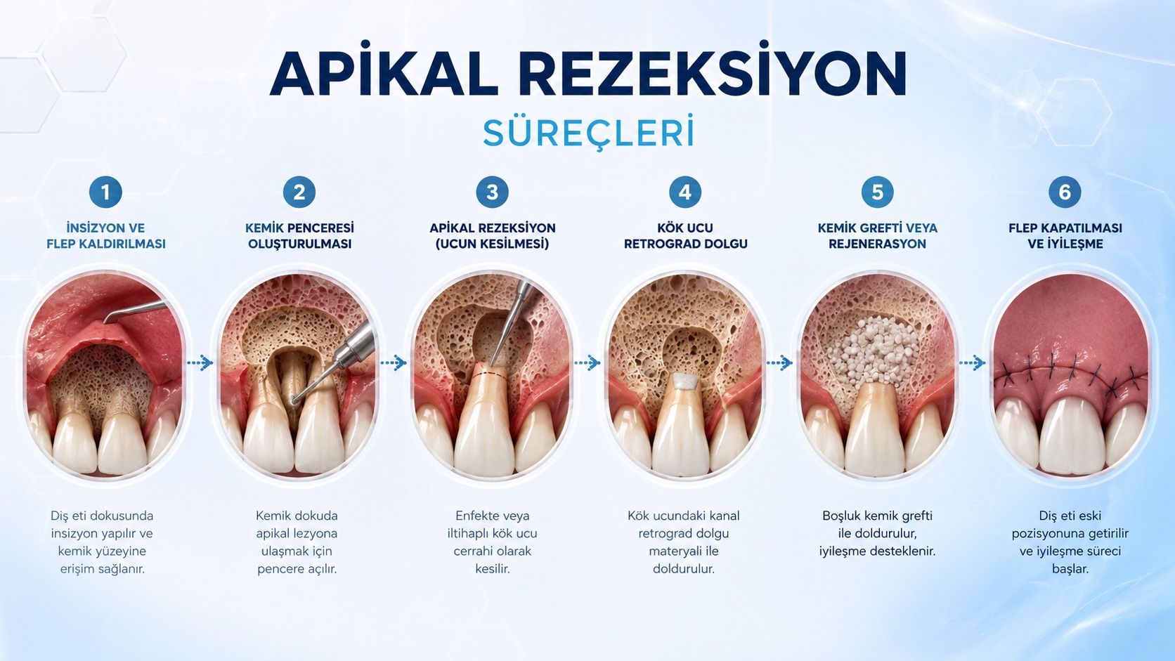 Apikal rezeksiyon cerrahi işlem süreci: anestezi, flap açılması, kök ucu kesimi ve retrograd dolgu adımları