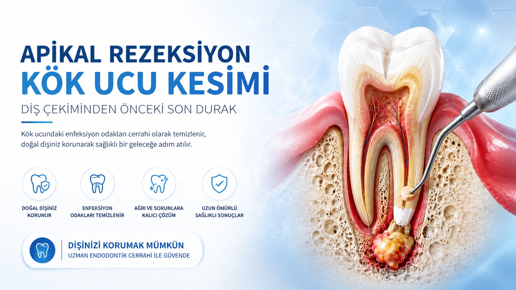 Apikal rezeksiyon (kök ucu kesimi) ile diş çekiminden önce dişi kurtarma tedavisi