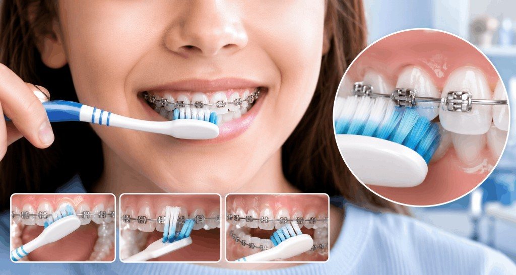 Diş teli varken diş fırçalama teknikleri: braket etrafı temizlik ve ortodontik ağız bakımı